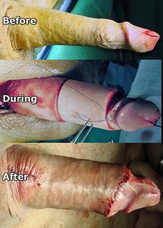plga-girth-enhancement-before-during-after (1)