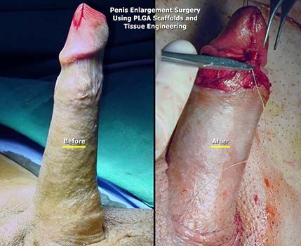 penis-enlargement-surgery-md